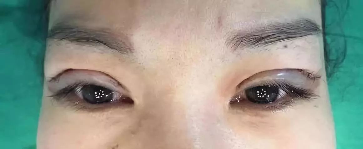 请别再怀疑潘贰做双眼皮手术切肌肉了，希望这是我最后一次澄清