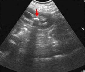 泌尿系统结石是什么,泌尿系统的结石有哪些