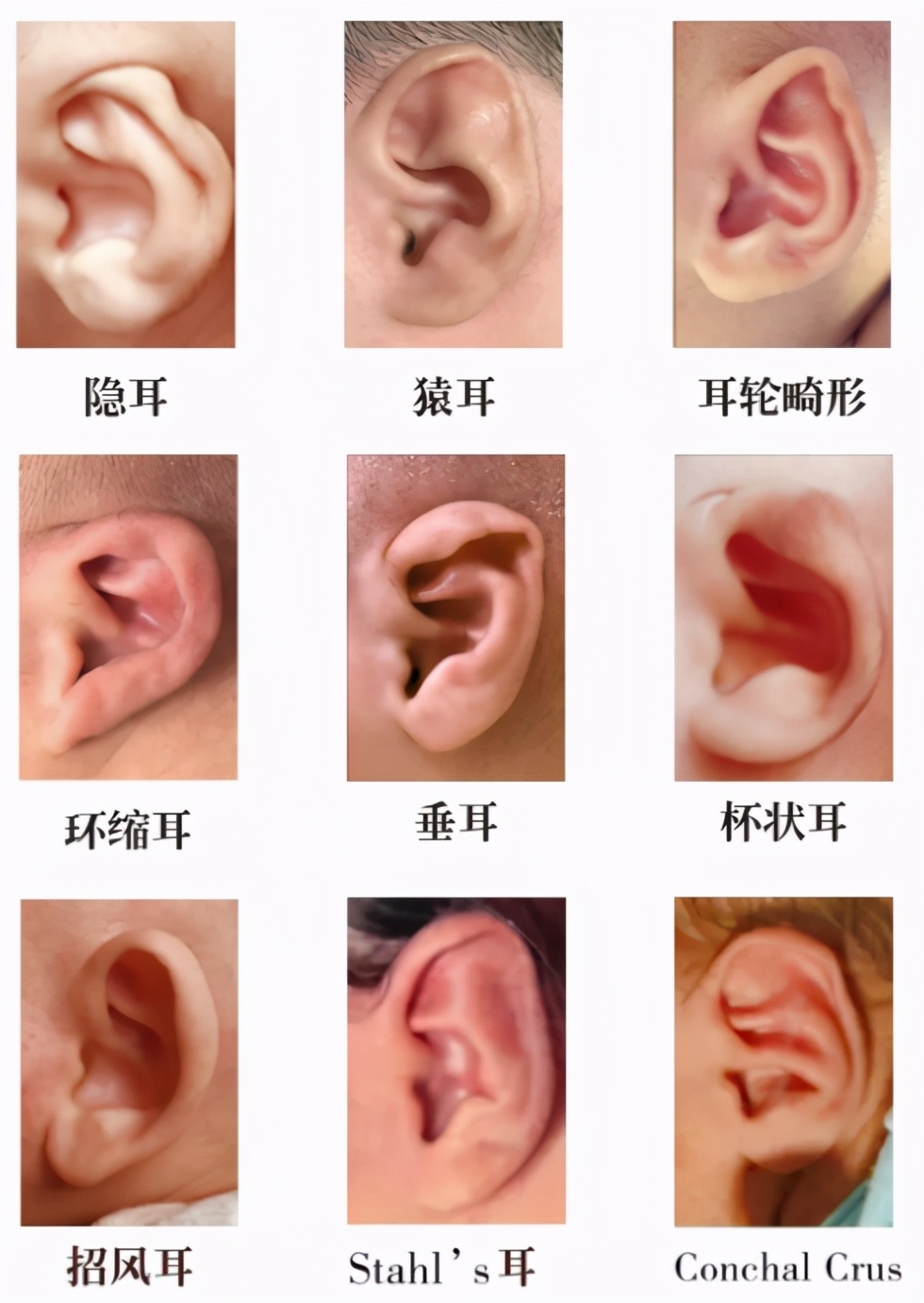 余文林小耳畸形失败案例,成人耳朵畸形能矫正吗效果怎么样