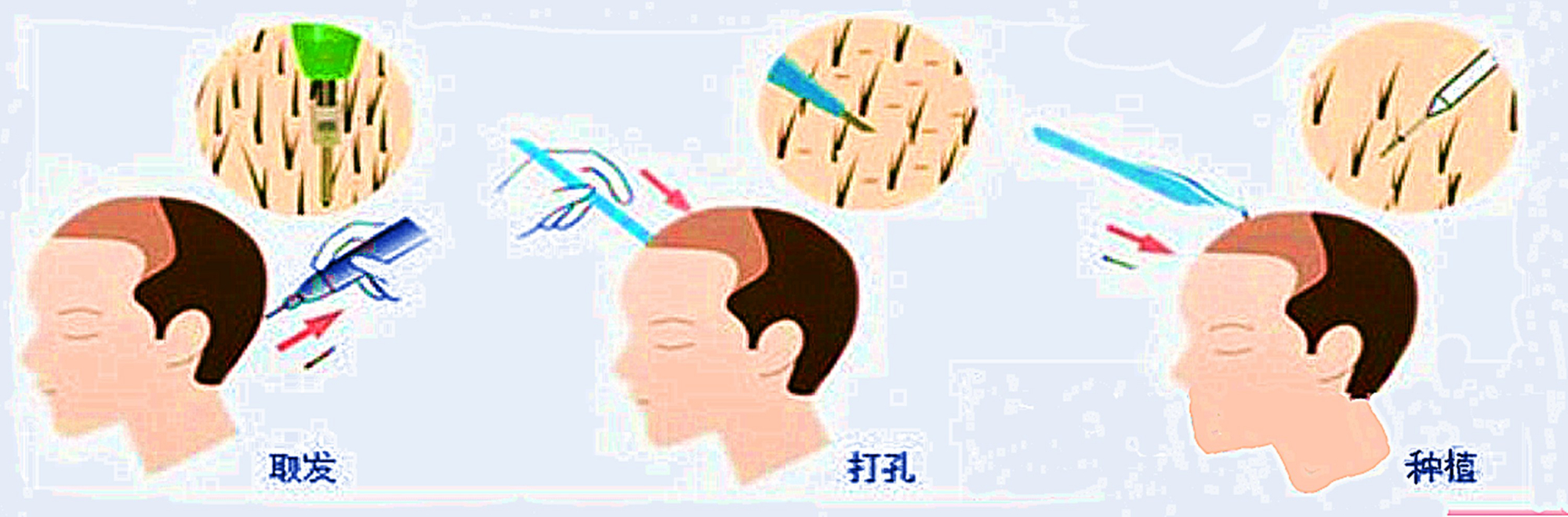 植发手术麻醉过程疼吗,植发手术麻醉过了会不会痛