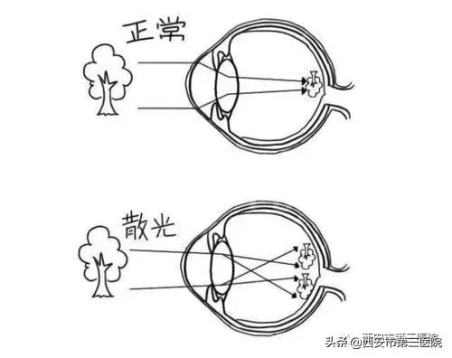 眼科医生怎么知道你有散光,眼科知识常见问题大全