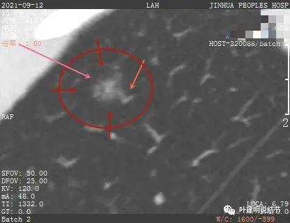 怎样从病理报告看是不是原位癌,原位腺癌切除子宫要开刀吗