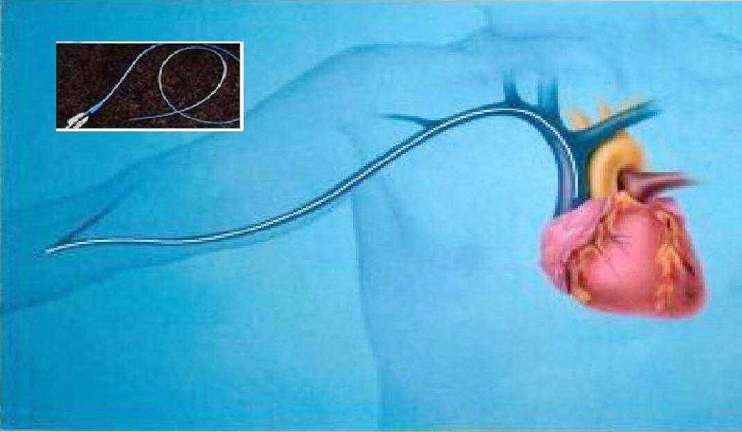 b超下picc置管操作流程,超声引导下picc中心静脉置管