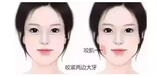 瘦脸针的5个常见问题,瘦脸针其实副作用挺大的