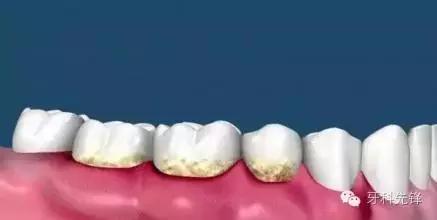 洗牙每年洗一次对牙齿好吗,多久洗一次牙为好洗牙多少钱