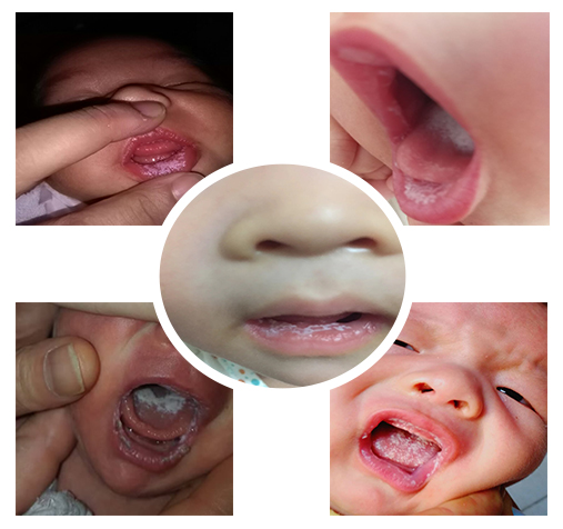 鹅口疮反反复复的怎么办,鹅口疮老是反反复复怎么办