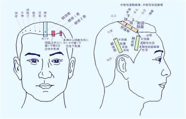 脑血栓偏瘫最好的治疗方法,如何预防脑血栓及中风发生