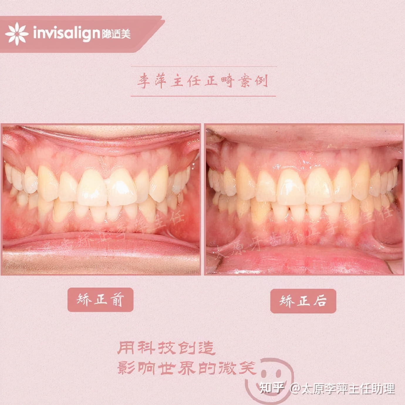 重度拥挤矫正牙齿适合隐形牙套吗,广州成人牙齿矫正推荐隐形牙套