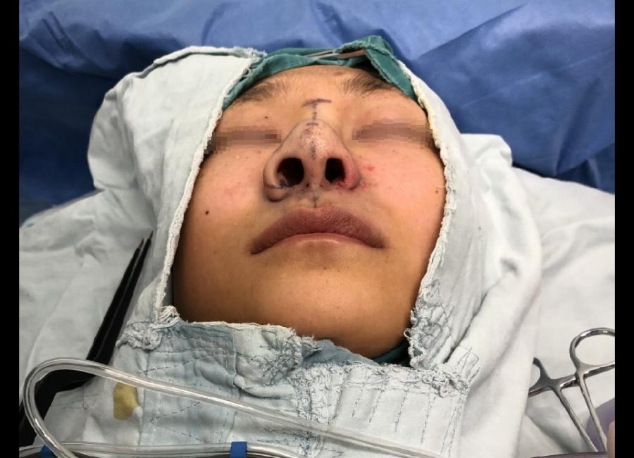 鼻翼缩小和鼻头缩小需要全麻吗,鼻头缩小和鼻翼缩小有什么区别