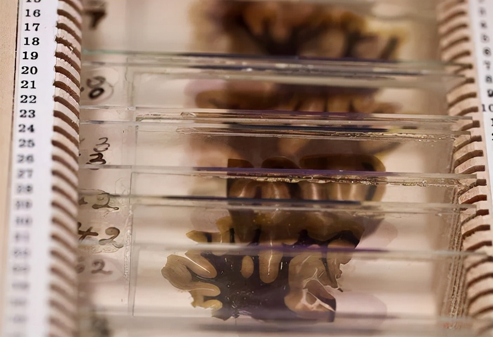 爱因斯坦的大脑解剖全过程,爱因斯坦的大脑为科学奉献一生