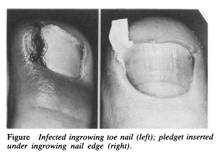 什么原因导致脚趾甲老是嵌甲,脚趾甲老是长到肉里怎么治疗啊