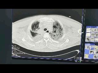 肺癌Ⅰ期术后咳嗽厉害，情况危急，抢救后血氧仍然很低，怎么办？