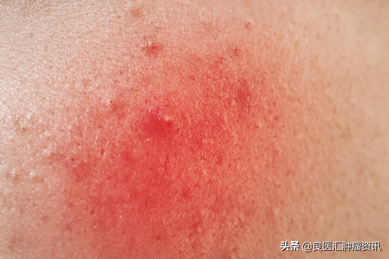 化疗后皮肤出现红疹子瘙痒吃什么,胰腺癌化疗之后皮肤瘙痒怎么回事