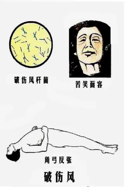 破伤风其实没那么可怕,科普关于破伤风的一些事儿