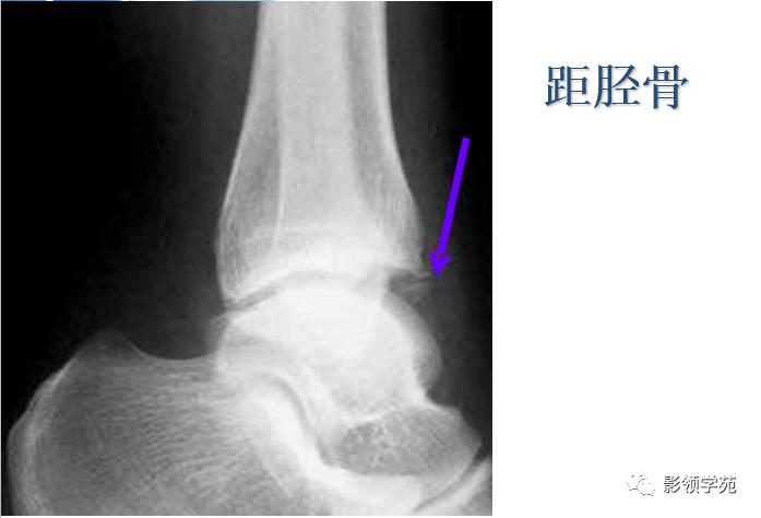 桡骨远端骨折引起尺骨变异,撕脱骨折一个月无明显骨痂形成