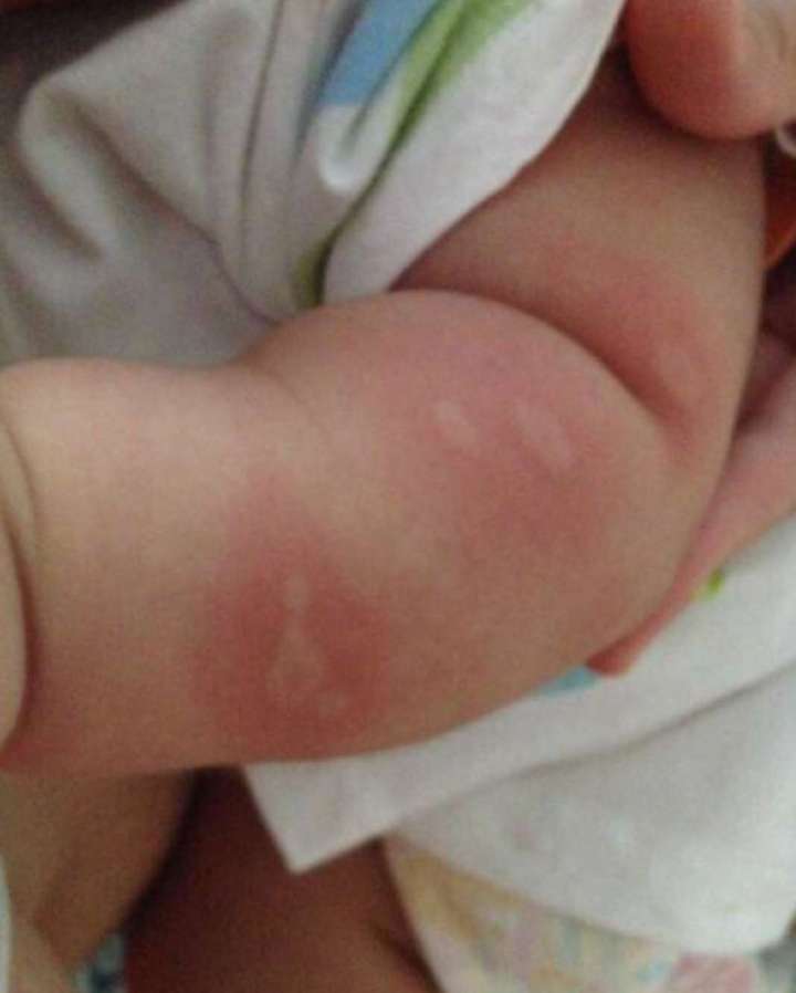 婴儿被蚊虫叮咬反应这么强烈,婴儿反复被蚊虫叮咬有什么危害