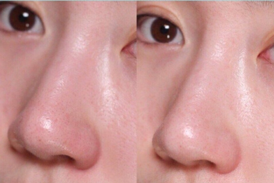 阿娇独家简单去黑头保姆级教程，再也不担心和男神近距离接触了