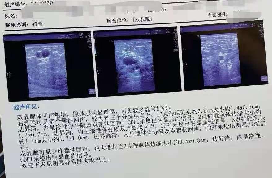 哺乳期乳房疙疙瘩瘩的,哺乳期乳房有疙瘩影响乳汁吗