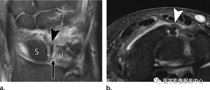 手腕撕脱性骨折一年了还隐隐作痛,手腕三角骨撕脱骨折症状有哪些