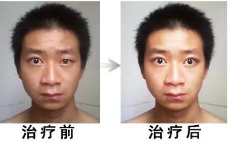 突发面瘫,突发面瘫治疗