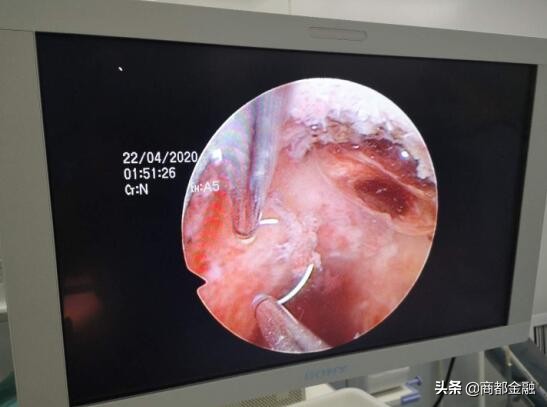 胎盘植入介入手术全过程妇产科,胎盘植入介入手术成功率高吗