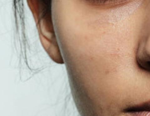 红痘印黑痘印怎么消除学生党,祛除痘印痘坑改善痘印化妆品