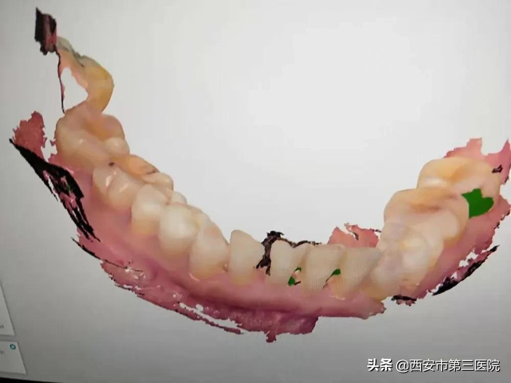 关注口腔健康的策划案例,关注口腔健康数字化种植牙