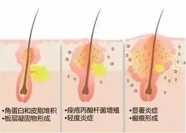 夏天痘印淡化得快吗,夏天到了痘印淡了