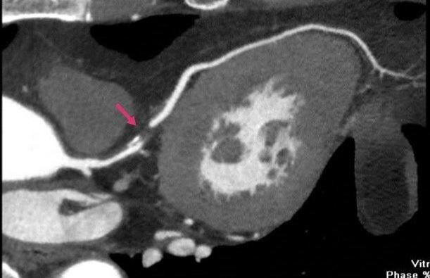 糖尿病人晚期心梗还有救吗,糖尿病心梗怎么治疗最好