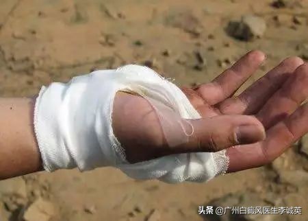 人身上为什么会出现白癜风,肉眼看不到的白癜风是属于什么