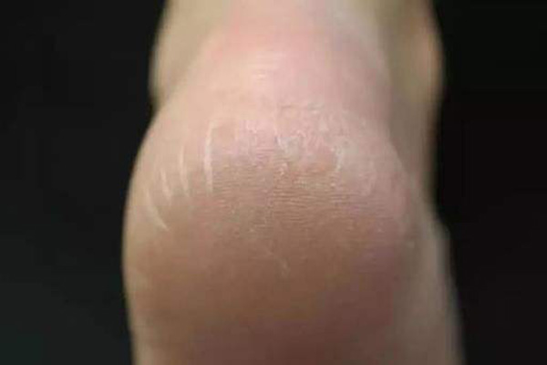 修脚神器去死皮磨脚刮脚后跟老茧,脚后跟死皮又厚又硬教你一招