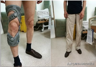 我不是“药神”,治疗膝骨关节炎,不用药