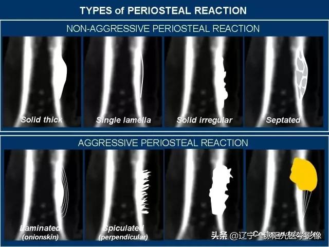 骨膜反应类型有哪几种,骨膜反应怎么快速恢复