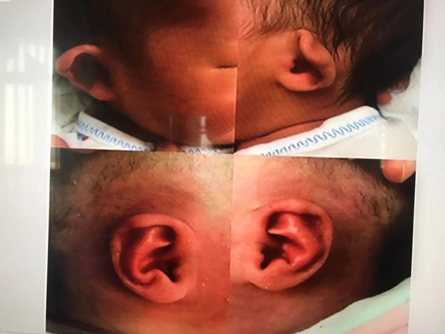 耳朵软骨畸形能矫正吗,新生儿耳朵畸形矫正费用大概多少