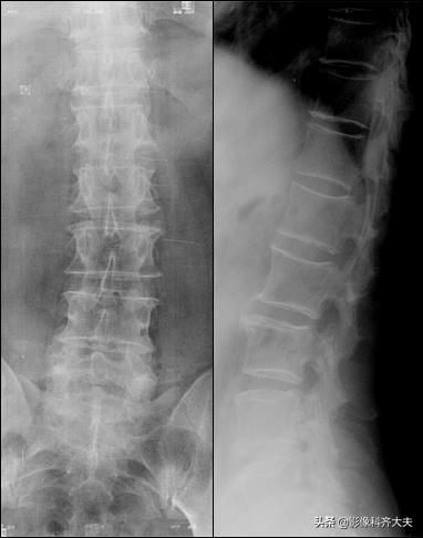 腰椎间盘突出最好的影像诊断方法,腰椎间盘突出的影像学检查