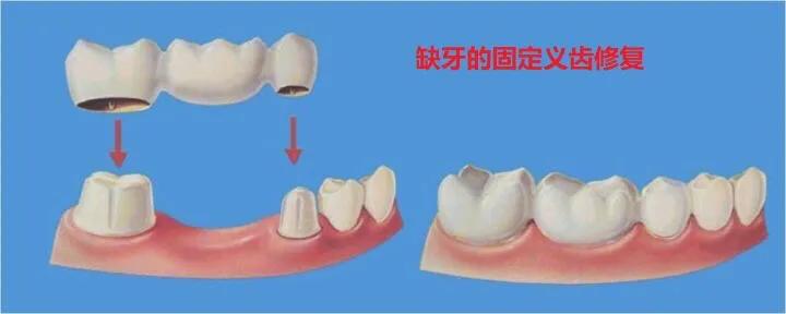 蛀牙不补能不能戴牙套,蛀牙不补认真刷牙可以防止变严重吗