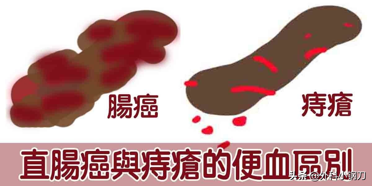 心好方，便便里面全是血，不想去医院，是不是癌啊，我该咋办？