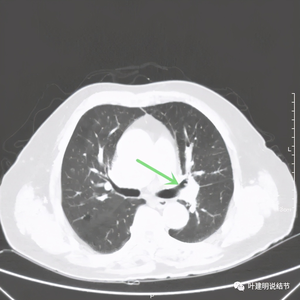卡瑞利珠单抗治疗肺鳞癌有用吗,特瑞普利单抗对鳞癌治疗有效吗