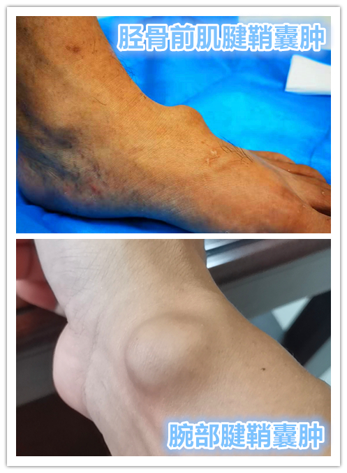 腱鞘囊肿开刀会碰到筋吗,腱鞘囊肿不想去医院自己怎样康复