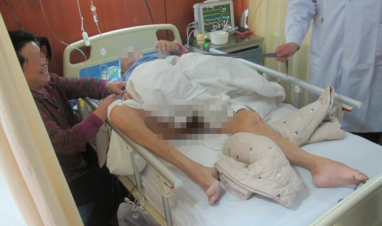 颅脑外伤术后脑积水,脑外伤脑积水颅骨缺失