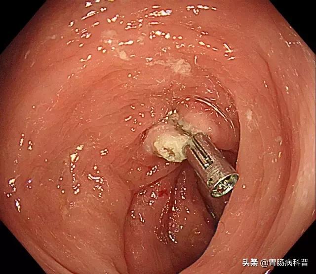 长了胃息肉怎么治疗好,长了胃息肉会有什么症状