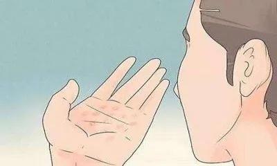 手脱皮止痒药膏,皮肤病手脱皮用什么药