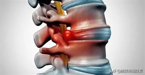 腰椎间盘退行性改变怎么治疗呢,腰椎退行性变和腰间盘突出哪个重