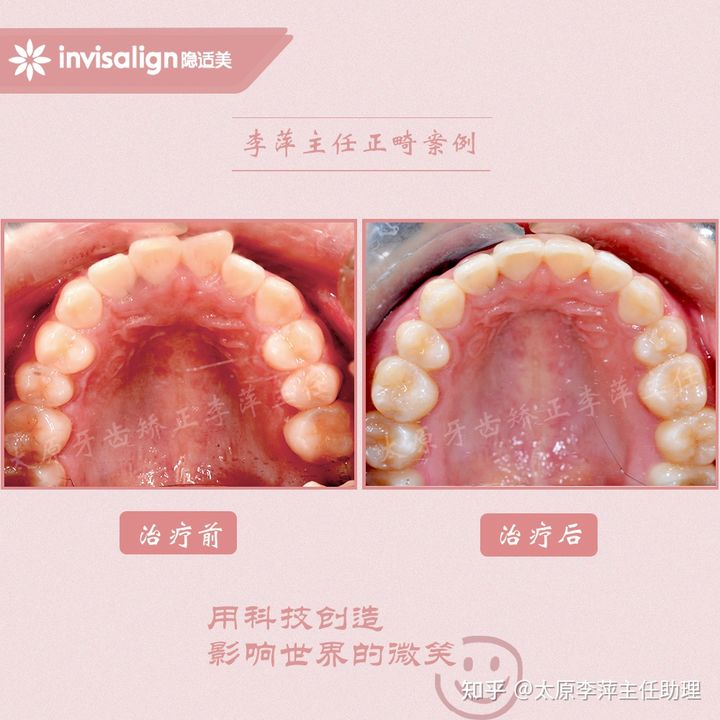 太原整牙齿矫正要多少钱,坏牙齿只剩牙根有必要拔牙吗
