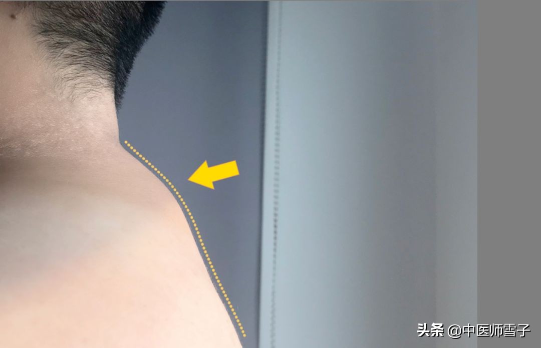 针灸拔罐祛富贵包的最快方法,富贵包针灸拔罐一次多少钱