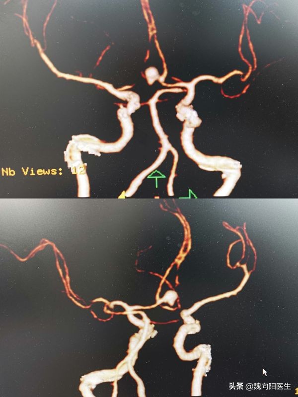 脑子里突然炸了一下,腰上有淤血要不要放血
