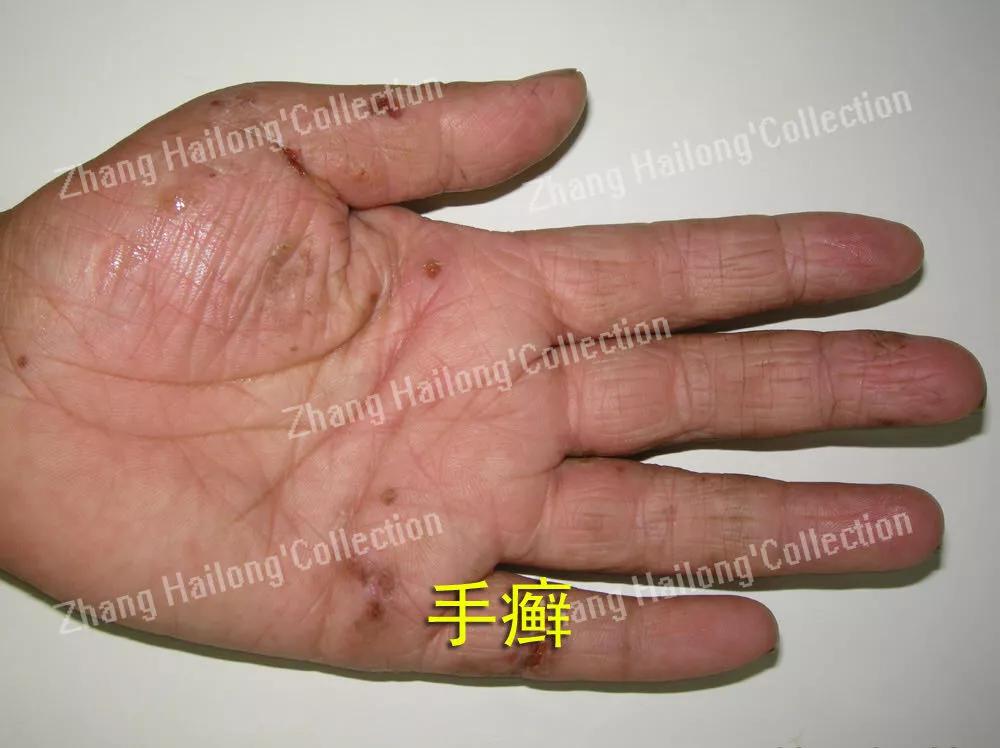 手特别干燥粗糙会是手癣吗,得了手癣指头皮肤变粗糙怎么办