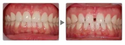 四十多岁门牙缝隙越来越大怎么办,儿童门牙缝隙越来越大原因