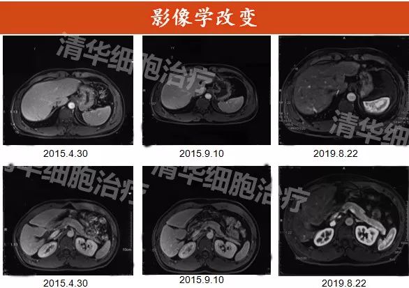 肝癌复发晚期最长生存期,肝癌术后复发怎么治