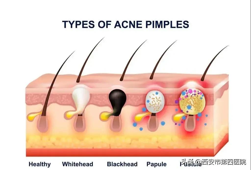 毛孔粗大家庭护肤的正确步骤,毛孔粗大正确护肤方法
